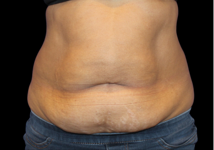 Liposuction Before & After Patient #2801