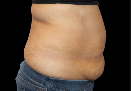 Liposuction Abdomen Before & After Patient #2801