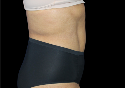 Liposuction Abdomen Before & After Patient #2801