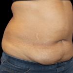 Liposuction Before & After Patient #2801