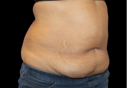 Liposuction Abdomen Before & After Patient #2801