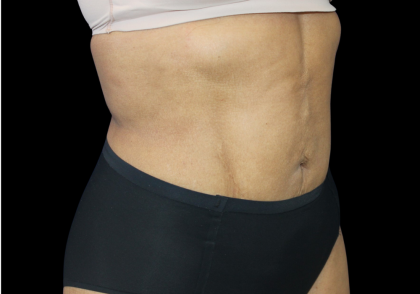 Liposuction Abdomen Before & After Patient #2801