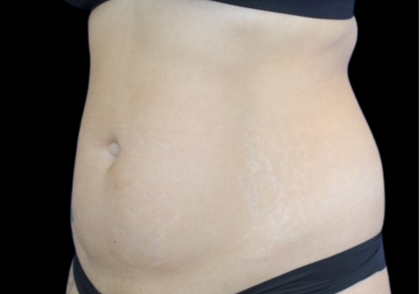 Liposuction Abdomen Before & After Patient #2803