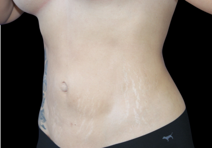 Liposuction Abdomen Before & After Patient #2803