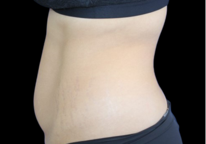 Liposuction Abdomen Before & After Patient #2803