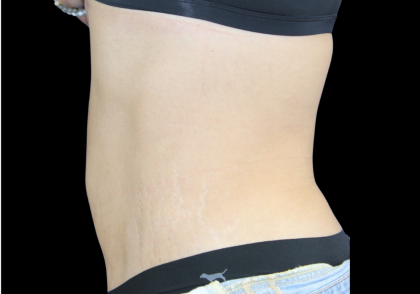 Liposuction Abdomen Before & After Patient #2803