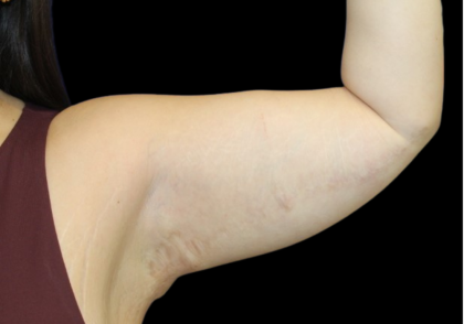 Liposuction to Arms Before & After Patient #2804