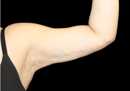 Liposuction to Arms Before & After Patient #2804