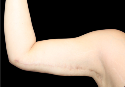 Liposuction to Arms Before & After Patient #2804