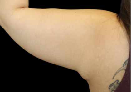 Liposuction to Arms Before & After Patient #2804