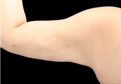 Liposuction to Arms Before & After Patient #2804