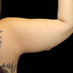 Liposuction to Arms Before & After Patient #2804