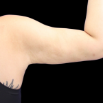 Liposuction to Arms Before & After Patient #2804