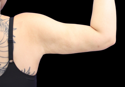 Liposuction to Arms Before & After Patient #2804