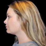 Neck Liposuction Before & After Patient #2816