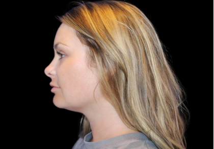 Neck Liposuction Before & After Patient #2816