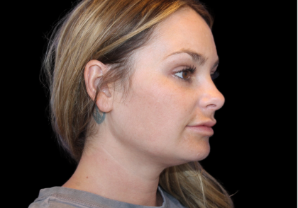 Neck Liposuction Before & After Patient #2816