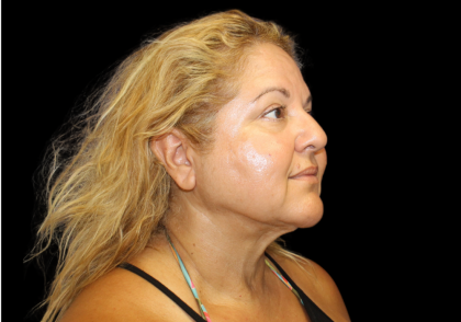 Neck Liposuction Before & After Patient #2826