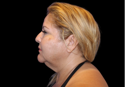 Neck Liposuction Before & After Patient #2826