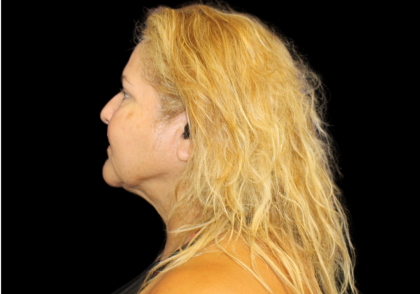 Neck Liposuction Before & After Patient #2826