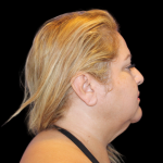 Neck Liposuction Before & After Patient #2826