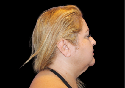 Neck Liposuction Before & After Patient #2826