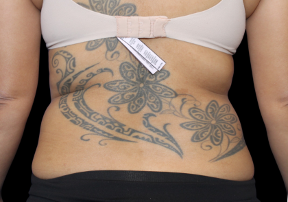 Liposuction Abdomen Before & After Patient #2802