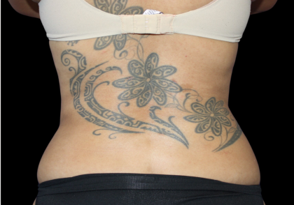 Liposuction Abdomen Before & After Patient #2802