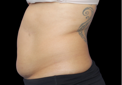 Liposuction Abdomen Before & After Patient #2802