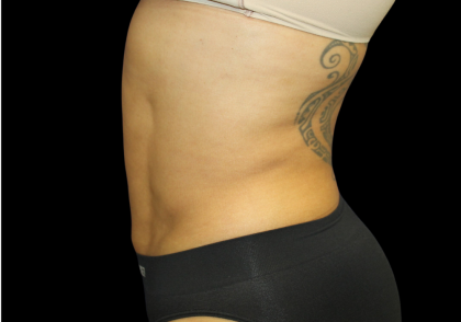 Liposuction Abdomen Before & After Patient #2802