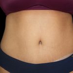 Tummy Tuck Before & After Patient #2499