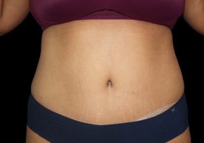 Tummy Tuck Before & After Patient #2499