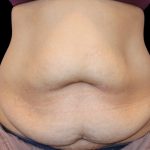 Tummy Tuck Before & After Patient #2499