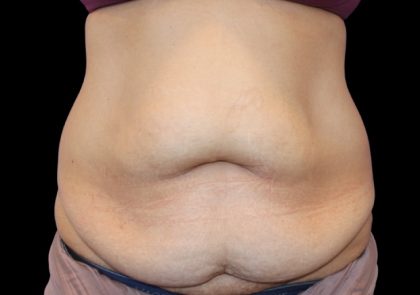 Tummy Tuck Before & After Patient #2499