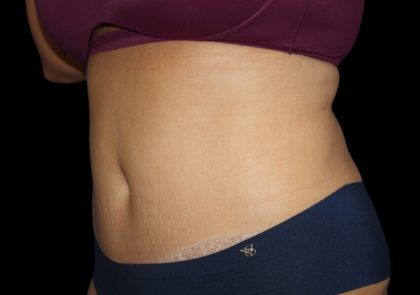 Tummy Tuck Before & After Patient #2499