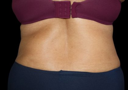 Tummy Tuck Before & After Patient #2499