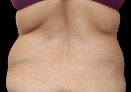 Tummy Tuck Before & After Patient #2499