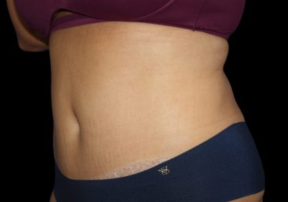 Tummy Tuck Before & After Patient #2499