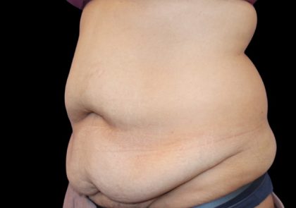 Tummy Tuck Before & After Patient #2499