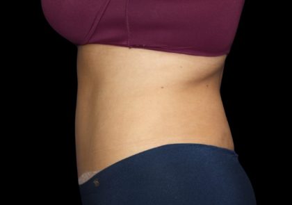 Tummy Tuck Before & After Patient #2499