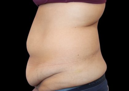 Tummy Tuck Before & After Patient #2499