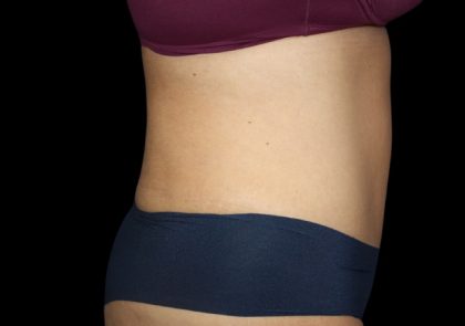 Tummy Tuck Before & After Patient #2499