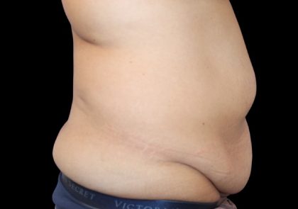 Tummy Tuck Before & After Patient #2499