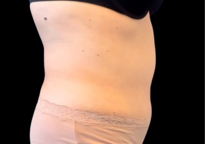 Tummy Tuck Before & After Patient #2497