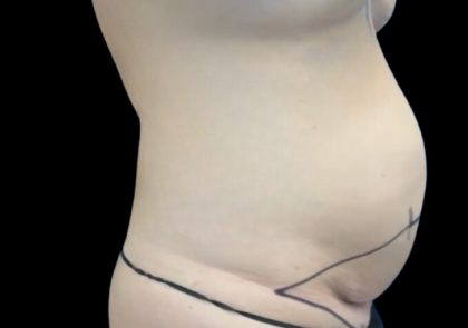 Tummy Tuck Before & After Patient #2497