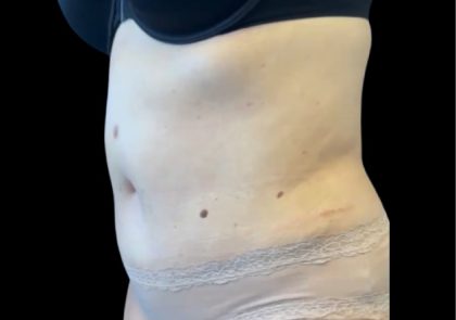 Tummy Tuck Before & After Patient #2497