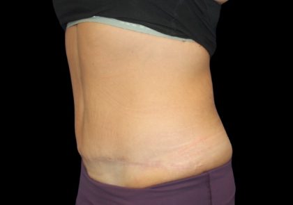 Tummy Tuck Before & After Patient #2498