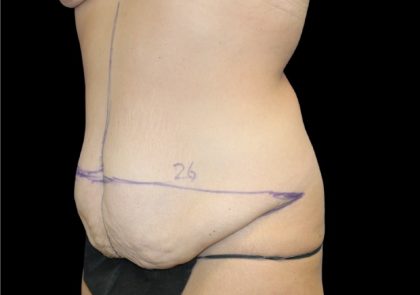 Tummy Tuck Before & After Patient #2498