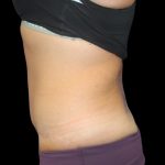 Tummy Tuck Before & After Patient #2498