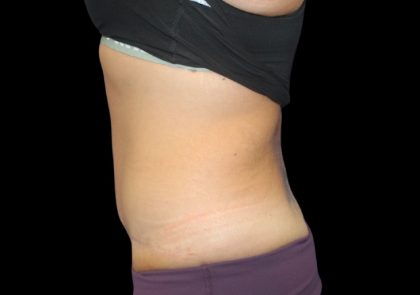 Tummy Tuck Before & After Patient #2498